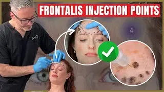 Injecting the Frontalis | Botox Injection Points & Safety Advice