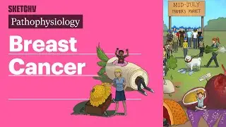 Breast Cancer (Pathophysiology) | Sketchy Medical
