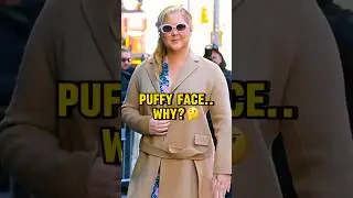 Amy Schumer's Cushing’s Syndrome:Symptoms reveaed #shorts #amyschumer #cushing
