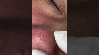 Massive Sebum Removal 😱