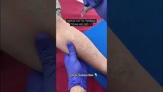 Hapus Tatto Terbaik Tidak Bikin Keloid | Laser Tatto Removal 