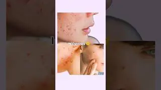 💁🏼Clear Your Acne & pimple Fast |  Proven Tips & Tricks to Clear skin ! 😉✨ #acne