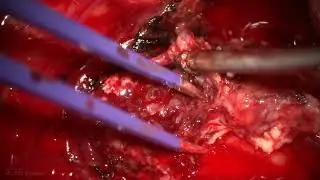 Suboccipital Craniotomy for Resection of a Tonsillar Cerebellar Arteriovenous Malformation