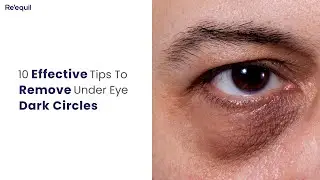 10 Effective Tips To Remove Under Eye Dark Circles