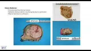 Skin - Pilomatrixoma (Gross pathology)