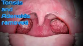Tonsils and Adenoids remove