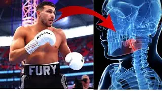 Tommy Fury HOSPITALIZED his sparring partner with broken jaw *NEW UPDATE*