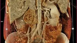 GDA and Pancreatic Mass with Cinematic Rendering