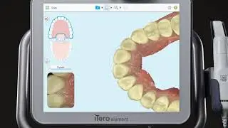 iTero® Scanner Tutorial: Using the Delete Tool