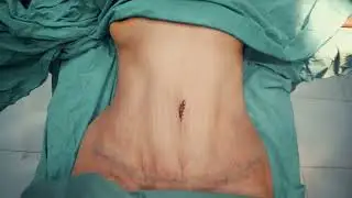 Dr Vüsal Abdullayev - Abdominoplastika