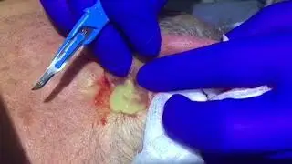 Drainage of an abscess behind the ear