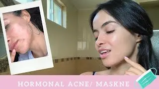 HORMONAL  ACNE/ MASKNE.  HOW I CLEAR MY SKIN  | 30 DAYS BEFORE AND AFTER