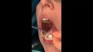 Dentist applying dental sealants