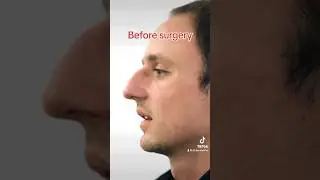 Incredible Male Rhinoplasty Results in only 6 weeks! #shorts #rhinoplasty