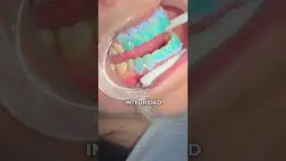Aclaramiento dental en el CONSULTORIO 🦷✨ #shorts