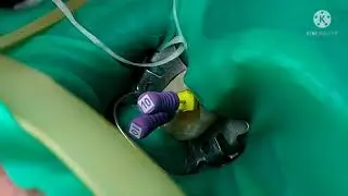 Root canal treatment: How root canal treatment is DONE STEP BY STEP! [BANDAGE CHANGE]