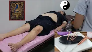 Prima mea experiență de acupunctură