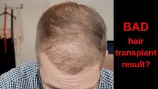 hair transplant turkey result after 16 weeks