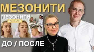 МЕЗОНИТИ ДО и ПОСЛЕ спустя 9 месяцев 
