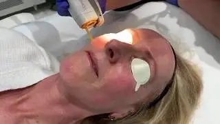 Vbeam Laser Treatment | Rosacea, Blood Vessels & Redness | West Hollywood, CA | Dr. Jason Emer