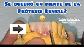 Cómo agregar un diente nuevo a la prótesis Dental? Reparación
