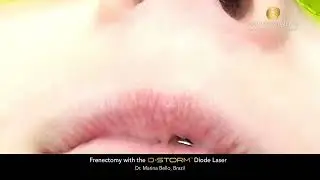 Frenectomy with the D-Storm™ Diode Laser