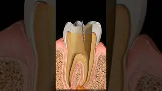 Root canal Therapy