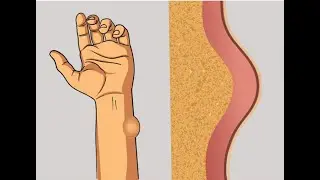 Podcast on Lipoma - Complete information on Lipoma Fat Lumps in English