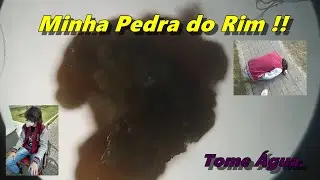 Pedra no Rim no Microscópio. ( Minha pedra no Rim).