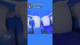 Restoring An Endodontically Treated Teeth 