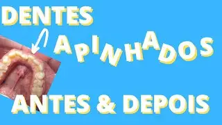Antes e Depois do Aparelho (Dente Encavalado)