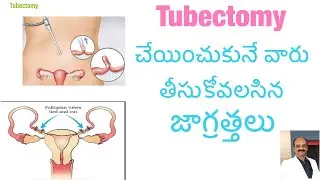 Tubectomy చేయించుకునే ముందు జాగ్రత్తలు/ precautions for Tubectomy operation/ anemia/high bp