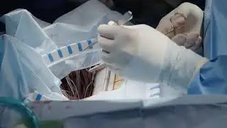 Koja je razlika između lupusa i fibromialgije?