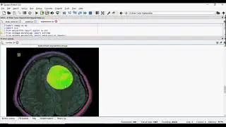 Brain Tumor Detection in Python