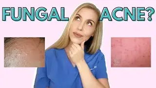 Do YOU have Fungal Acne? | Dermatologist Talks Symptoms and Treatments!