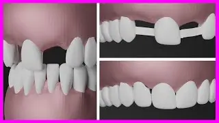 PERDI um DENTE e NÂO QUERO FAZER IMPLANTE veja uma alternativa ao implante dentário