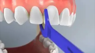 Maxilla Flossing with a Hand Tool