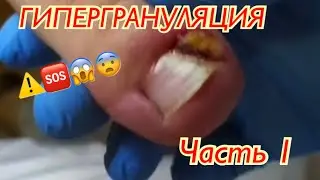 ГИПЕРГРАНУЛЯЦИЯ 🆘⚠️😱😨 • Часть 1