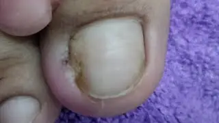 EXTREME INFECTED INGROWN TOENAIL REMOVAL