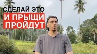 КАК я ВЫЛЕЧИЛ ПРЫЩИ (АКНЕ) за МЕСЯЦ