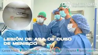 LESION DE ASA DE CUBO DE MENISCO