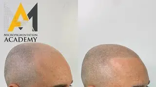 Best Scalp Micropigmentation By International Master Educator Anthonye Angelillo