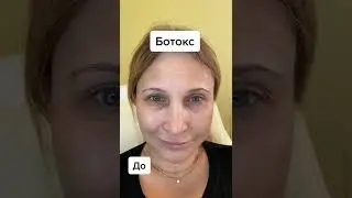 Ботокс. Результат до/после.