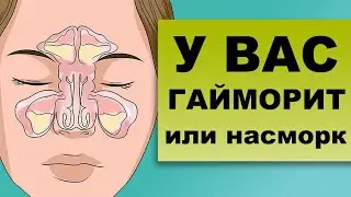 ГАЙМОРИТ. Все о заболевании: причины, симптомы, лечение
