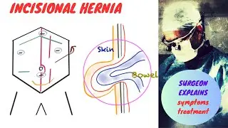 Incisional Hernia Symptoms and Treatment