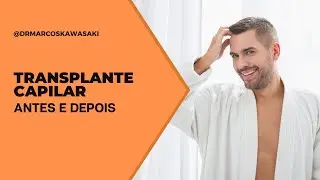 Resultado de Transplante Capilar | ANTES E DEPOIS