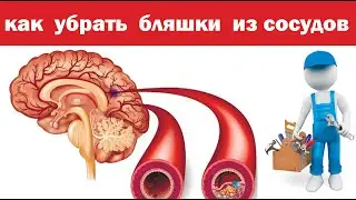Рецепт от сужения сосудов головного мозга. Как убрать бляшки.