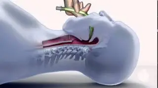 ACLS Using an  LMA