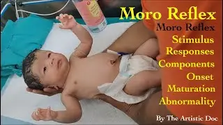 Moro Reflex | Infantile Reflex | Everything You need to Know About | Newborn  in SNCU