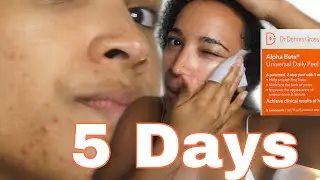 TRYING DR DENNIS GROSS ALPHA BETA PEEL FOR 5 DAYS